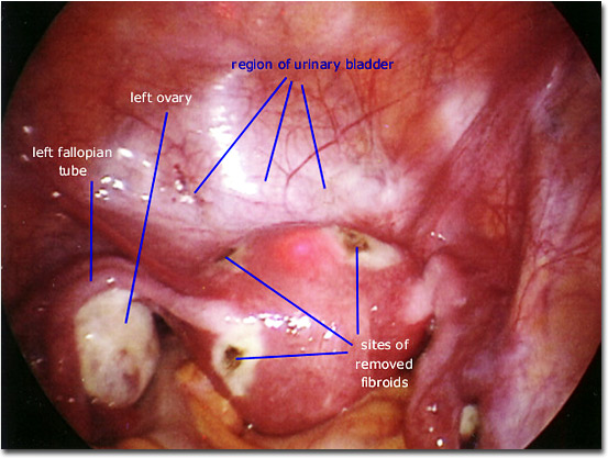  ... of Miscarriages and Available Treatments - Subserosal Fibroid View 2